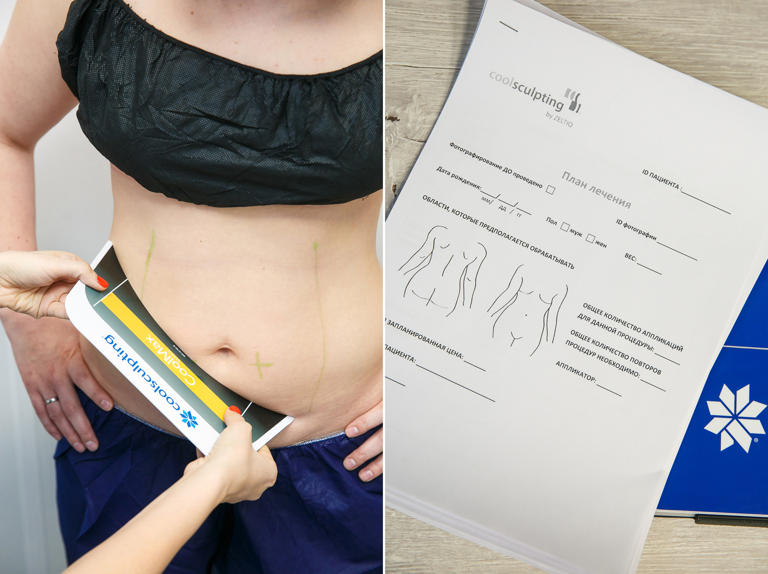 COME MODE Coolsculpting