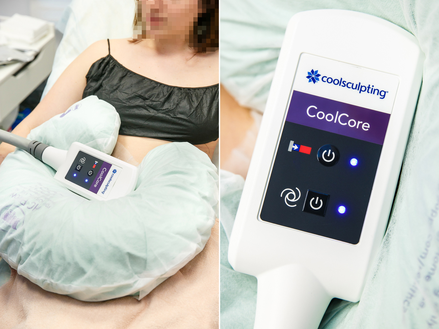 COME MODE Coolsculpting